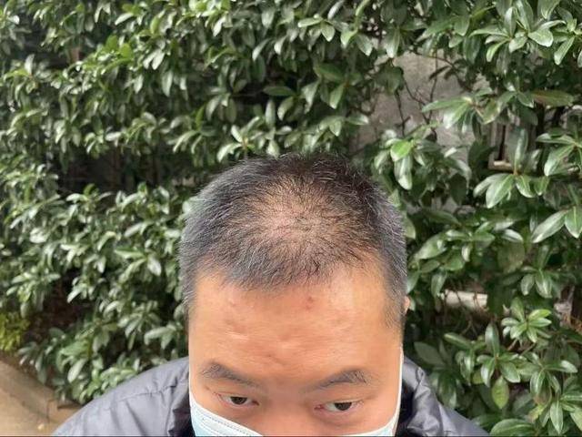 “还能反光<strong></p>
<p>币币交易模式优势</strong>！”长沙男子植发近9月称后脑勺“像狗啃过”