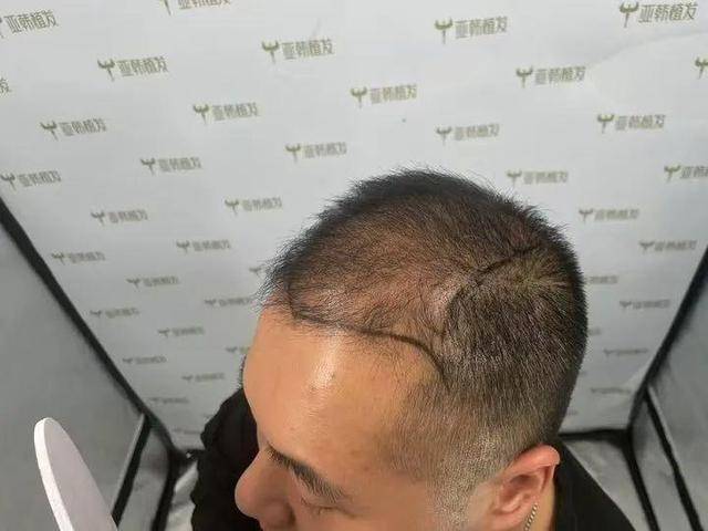“还能反光<strong></p>
<p>币币交易模式优势</strong>！”长沙男子植发近9月称后脑勺“像狗啃过”