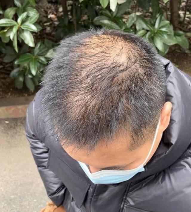 “还能反光<strong></p>
<p>币币交易模式优势</strong>！”长沙男子植发近9月称后脑勺“像狗啃过”